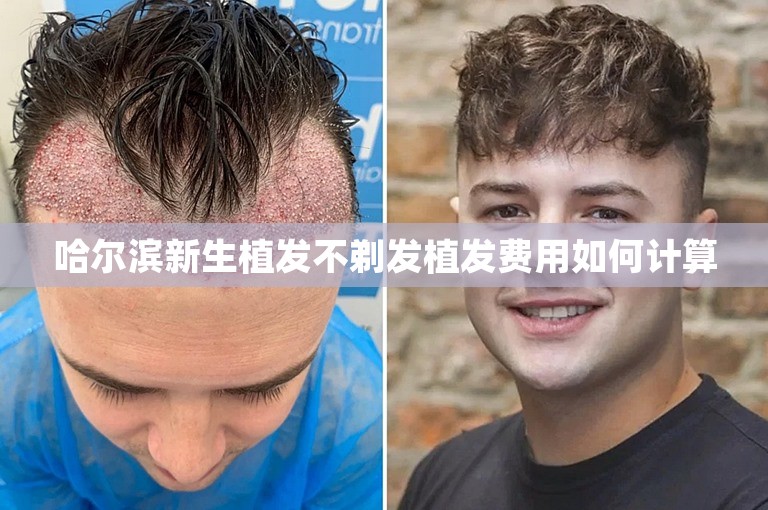 哈尔滨新生植发不剃发植发费用如何计算