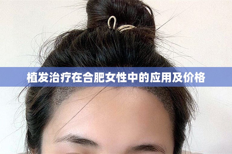 植发治疗在合肥女性中的应用及价格