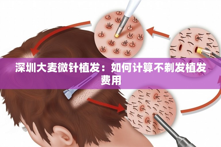 深圳大麦微针植发：如何计算不剃发植发费用