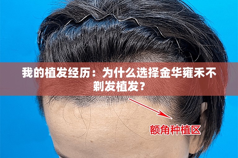 我的植发经历：为什么选择金华雍禾不剃发植发？