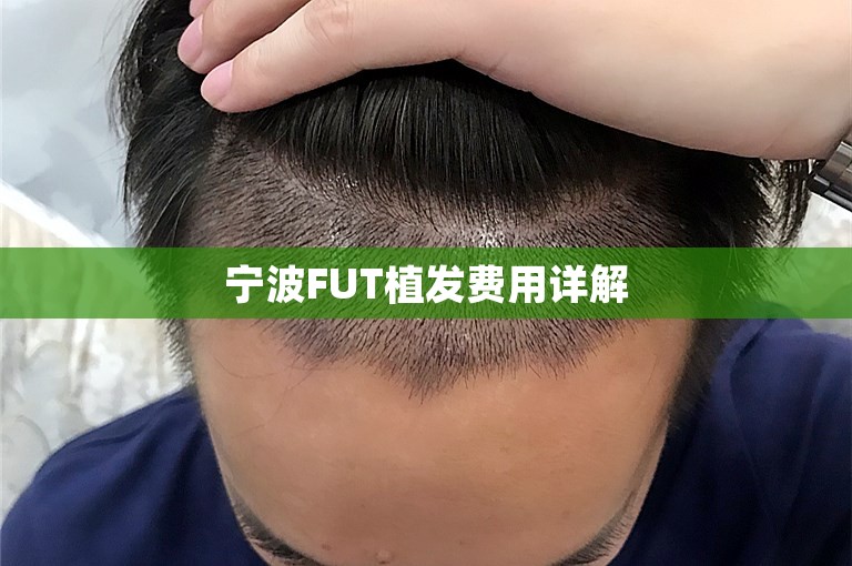 宁波FUT植发费用详解