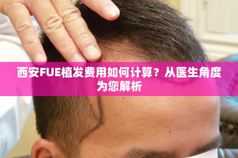 西安FUE植发费用如何计算？从医生角度为您解析