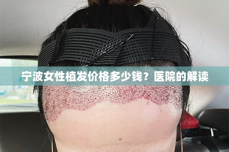 宁波女性植发价格多少钱？医院的解读