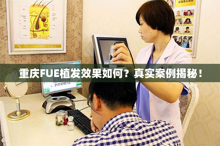 重庆FUE植发效果如何？真实案例揭秘！