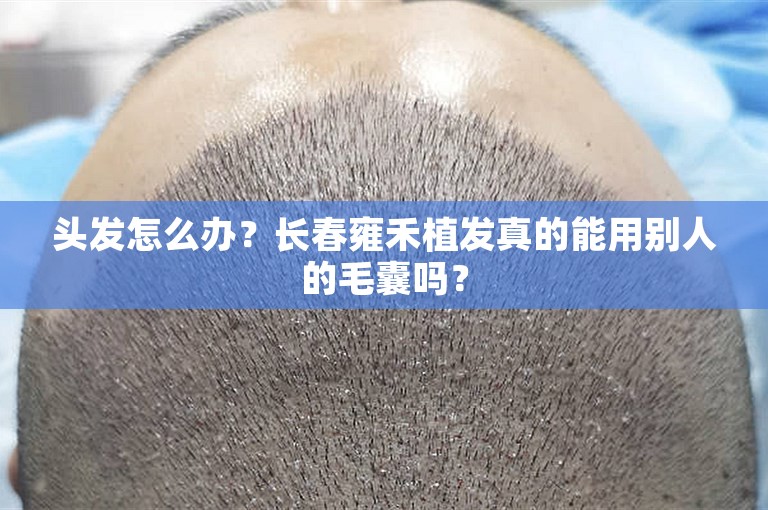 头发怎么办？长春雍禾植发真的能用别人的毛囊吗？