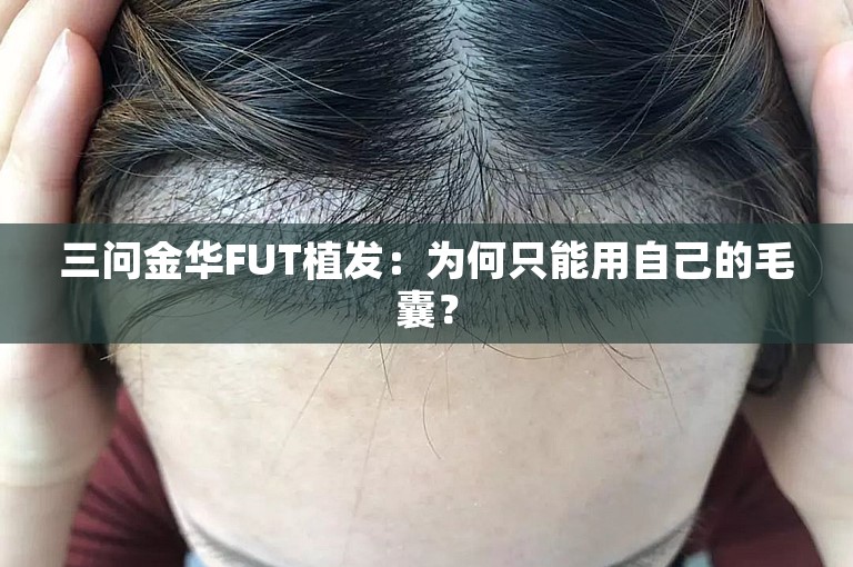 三问金华FUT植发：为何只能用自己的毛囊？