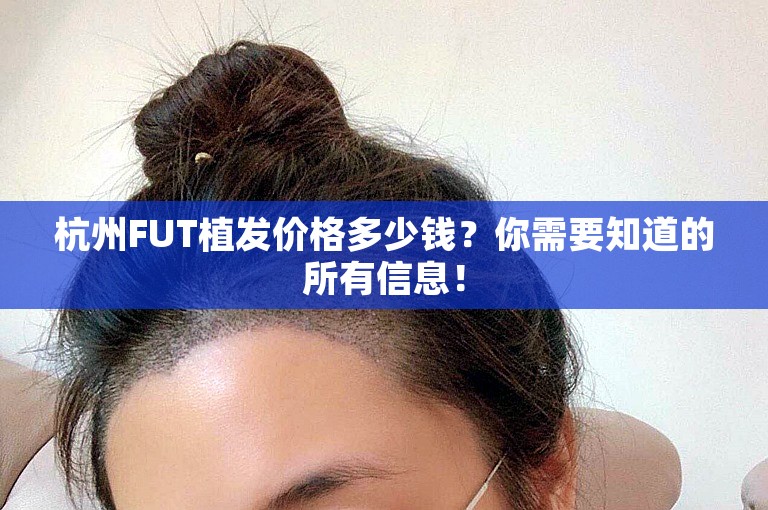 杭州FUT植发价格多少钱？你需要知道的所有信息！