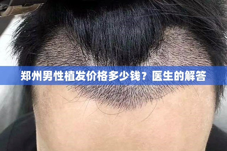 郑州男性植发价格多少钱？医生的解答