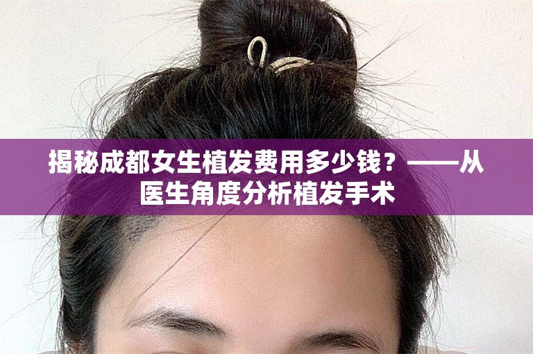 揭秘成都女生植发费用多少钱？——从医生角度分析植发手术