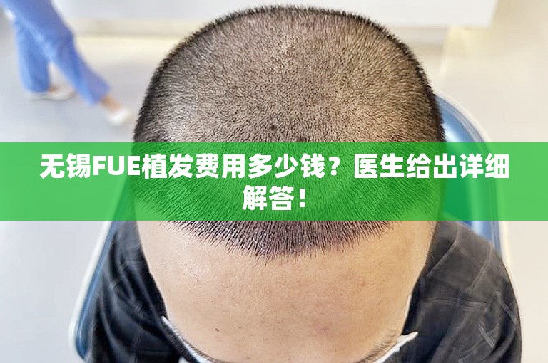 无锡FUE植发费用多少钱？医生给出详细解答！