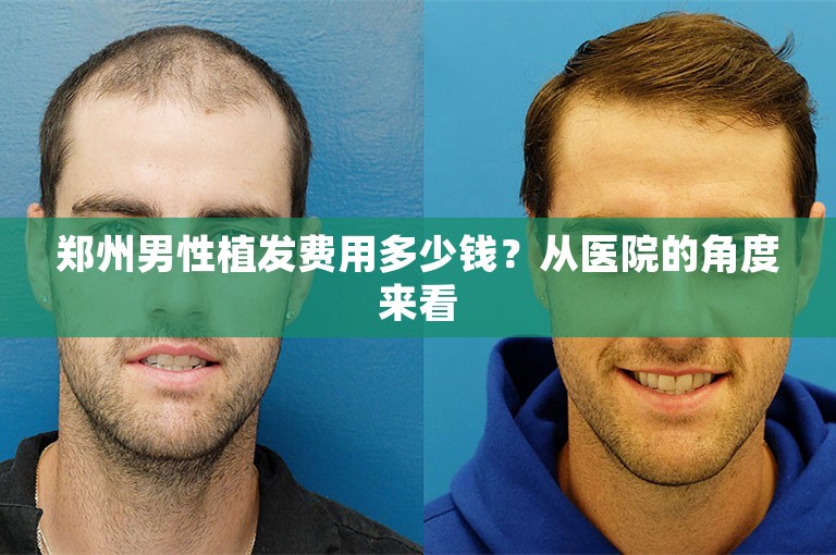 郑州男性植发费用多少钱？从医院的角度来看