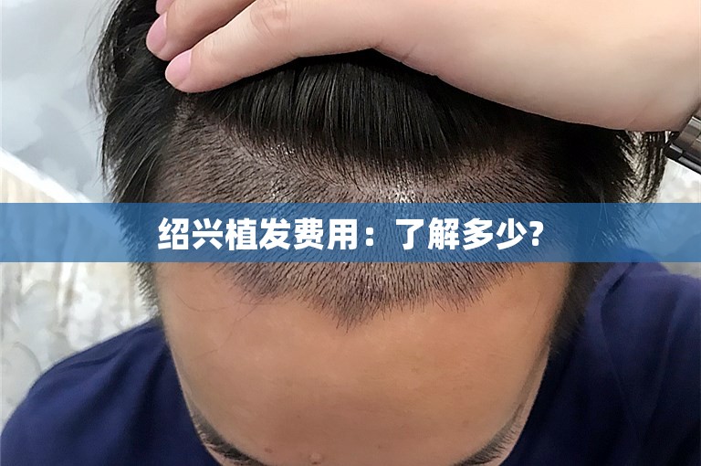 绍兴植发费用：了解多少?