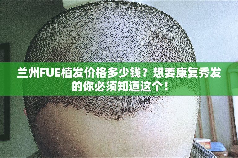 兰州FUE植发价格多少钱？想要康复秀发的你必须知道这个！