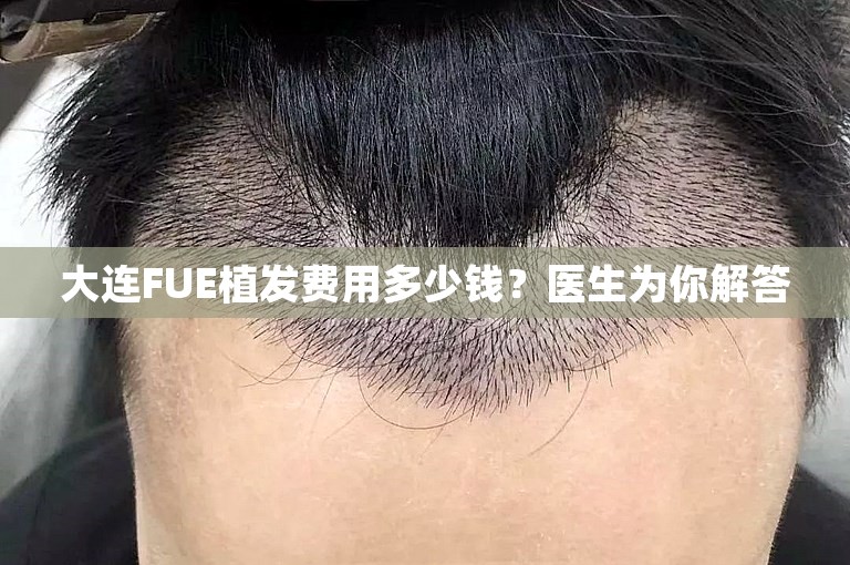 大连FUE植发费用多少钱？医生为你解答