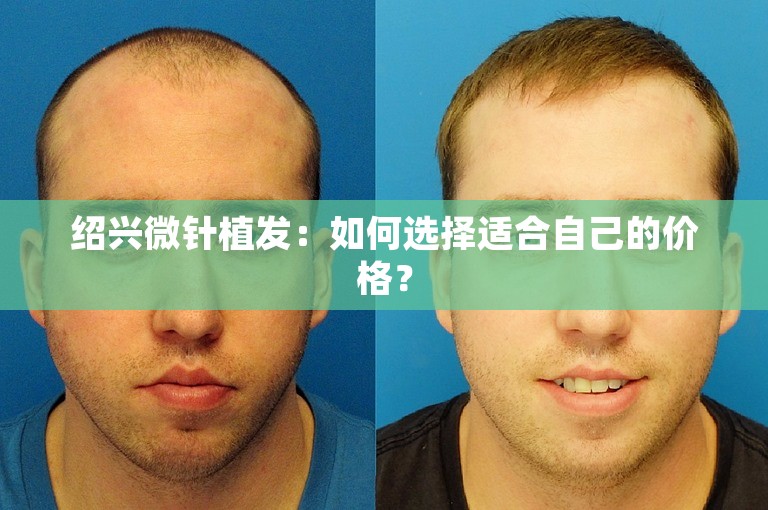 绍兴微针植发：如何选择适合自己的价格？