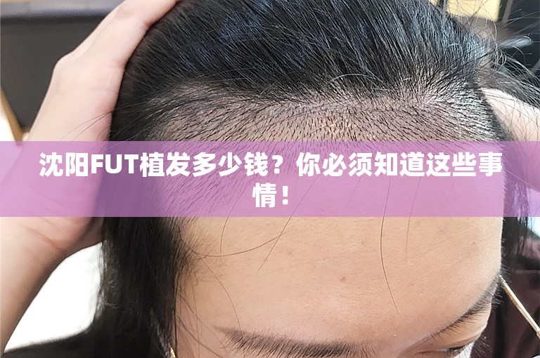 沈阳FUT植发多少钱？你必须知道这些事情！