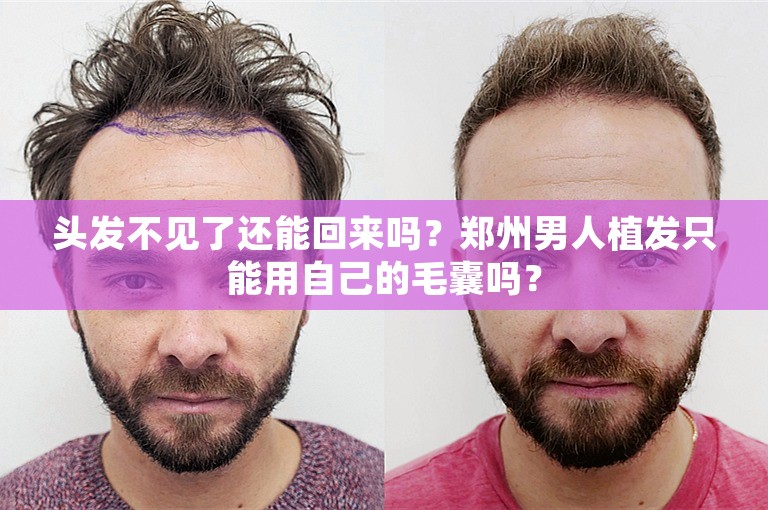 头发不见了还能回来吗？郑州男人植发只能用自己的毛囊吗？