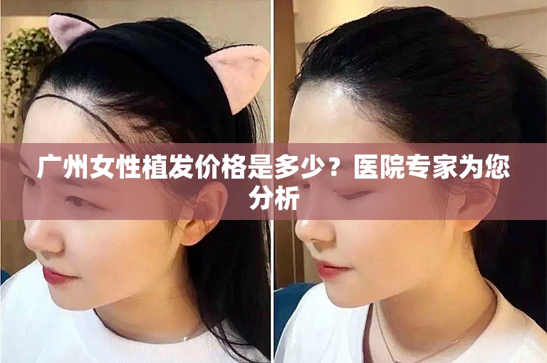 广州女性植发价格是多少？医院专家为您分析