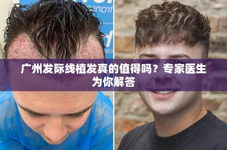 广州发际线植发真的值得吗？专家医生为你解答