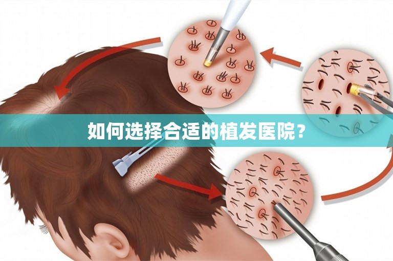 如何选择合适的植发医院？