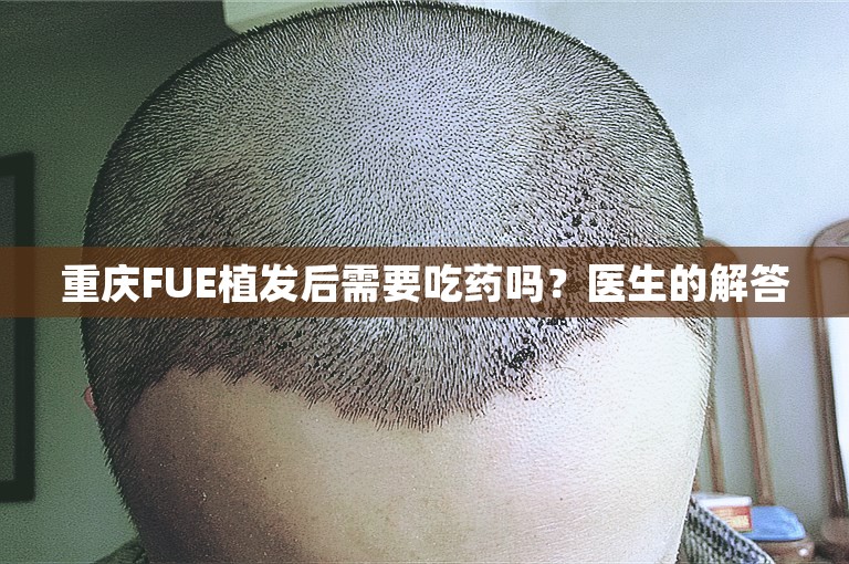 重庆FUE植发后需要吃药吗？医生的解答