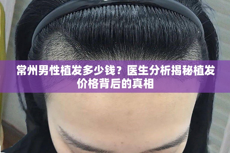 常州男性植发多少钱？医生分析揭秘植发价格背后的真相