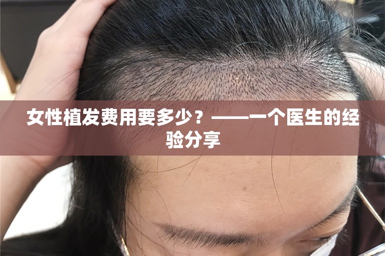 女性植发费用要多少？——一个医生的经验分享