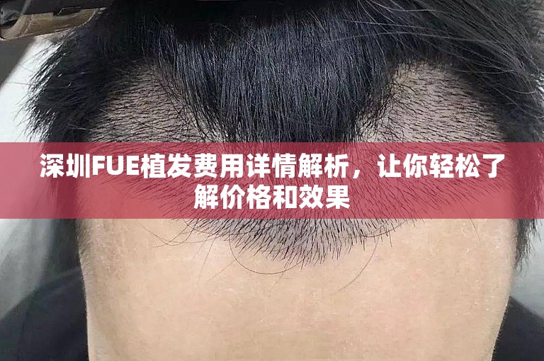 深圳FUE植发费用详情解析，让你轻松了解价格和效果