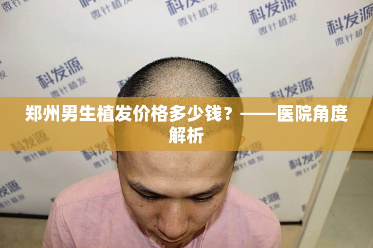 郑州男生植发价格多少钱？——医院角度解析