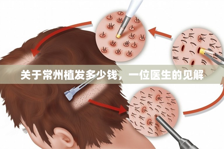 关于常州植发多少钱，一位医生的见解