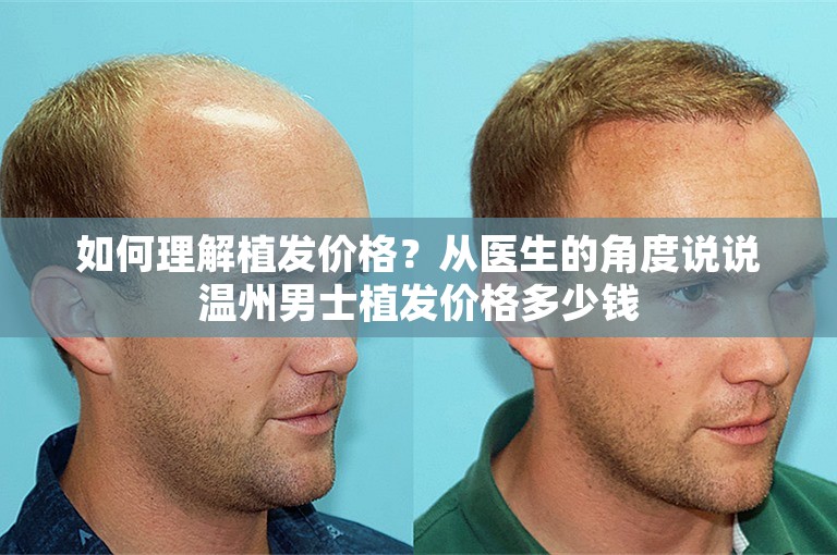 如何理解植发价格？从医生的角度说说温州男士植发价格多少钱