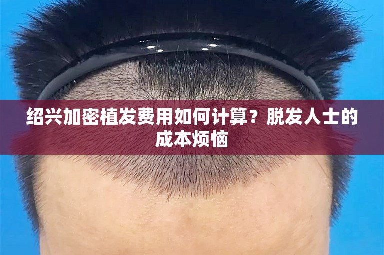 绍兴加密植发费用如何计算？脱发人士的成本烦恼