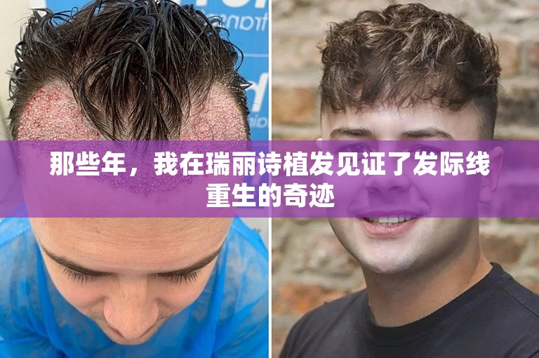 那些年，我在瑞丽诗植发见证了发际线重生的奇迹