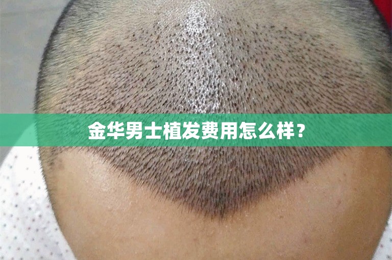 金华男士植发费用怎么样？