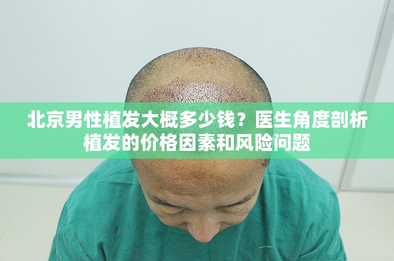 北京男性植发大概多少钱？医生角度剖析植发的价格因素和风险问题