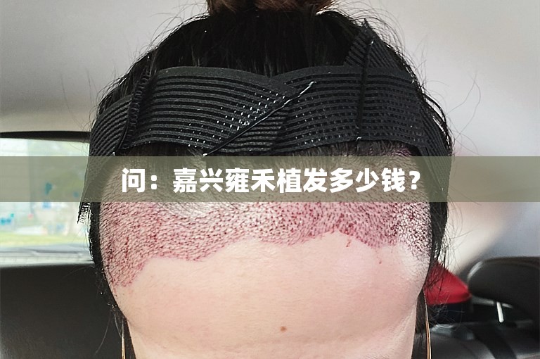 问：嘉兴雍禾植发多少钱？