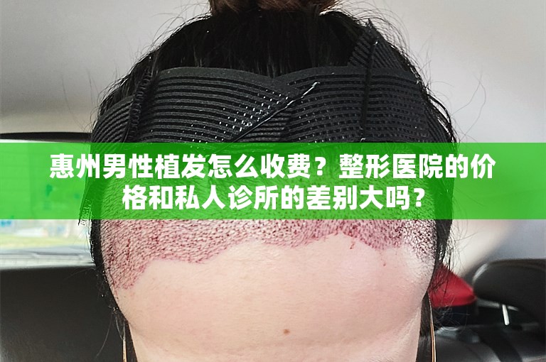 惠州男性植发怎么收费？整形医院的价格和私人诊所的差别大吗？