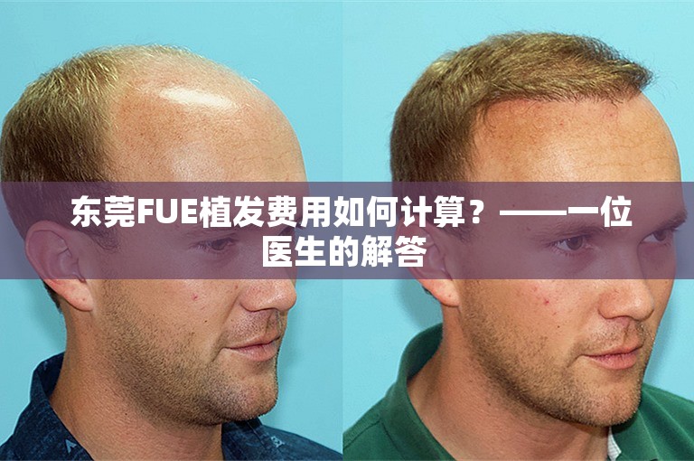  东莞FUE植发费用如何计算？——一位医生的解答 