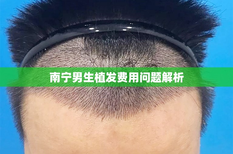 南宁男生植发费用问题解析