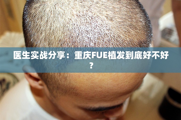 医生实战分享：重庆FUE植发到底好不好？