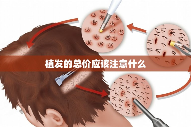 植发的总价应该注意什么