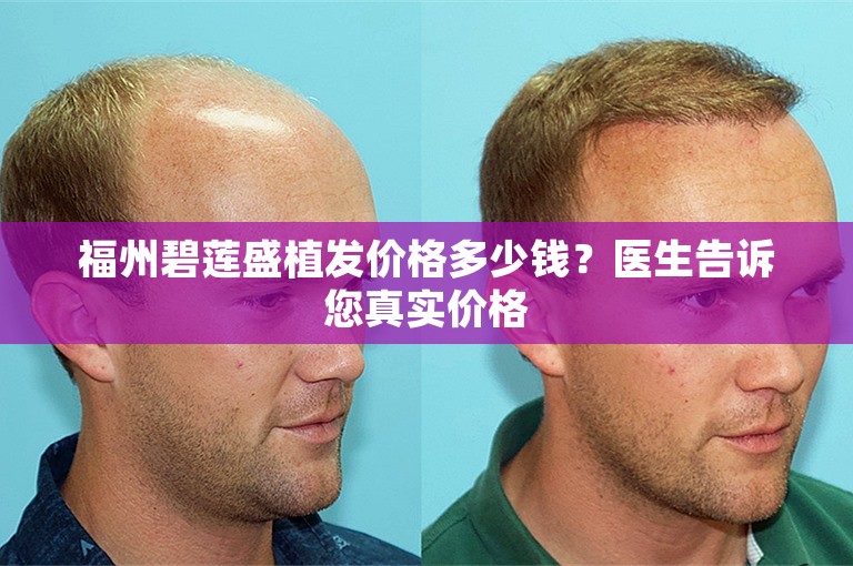 福州碧莲盛植发价格多少钱？医生告诉您真实价格