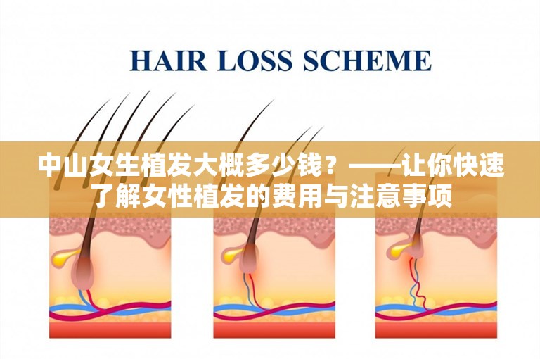 中山女生植发大概多少钱？——让你快速了解女性植发的费用与注意事项