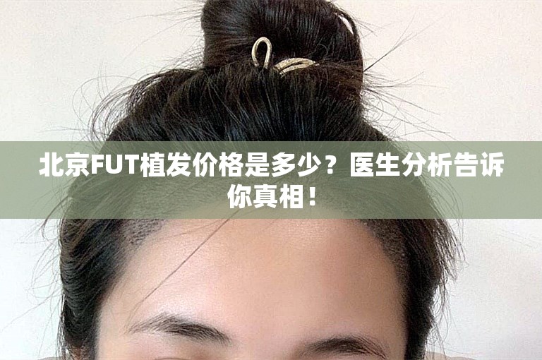 北京FUT植发价格是多少？医生分析告诉你真相！