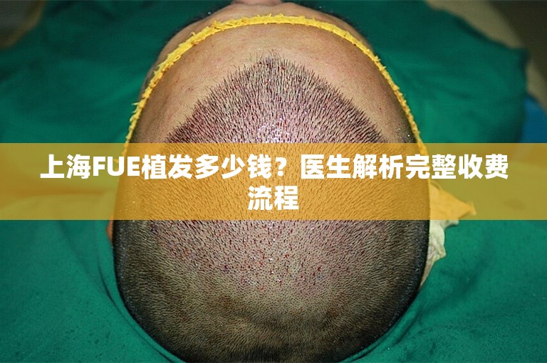 上海FUE植发多少钱？医生解析完整收费流程