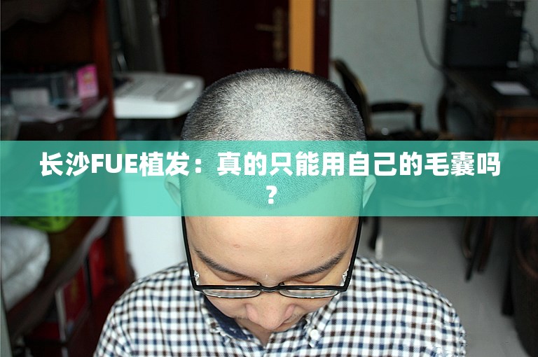 长沙FUE植发：真的只能用自己的毛囊吗？