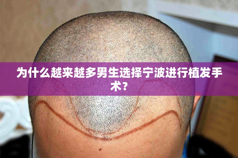 为什么越来越多男生选择宁波进行植发手术？