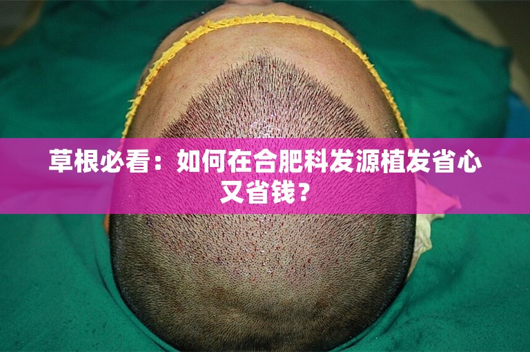 草根必看：如何在合肥科发源植发省心又省钱？