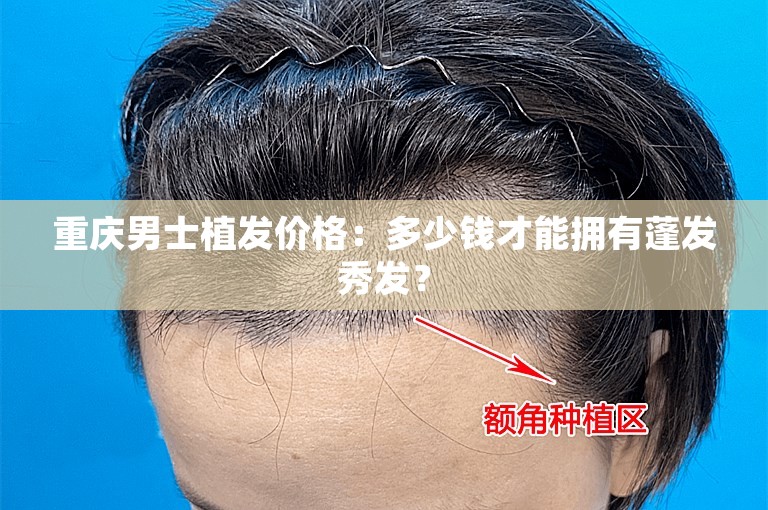 重庆男士植发价格：多少钱才能拥有蓬发秀发？