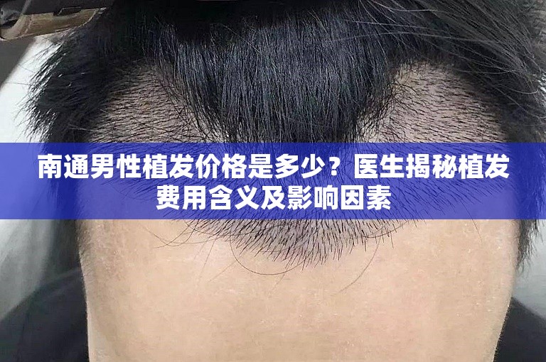 南通男性植发价格是多少？医生揭秘植发费用含义及影响因素